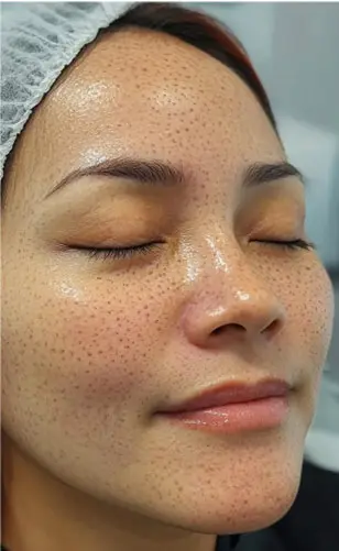 Burun Dolgusu Öncesi Sonrası