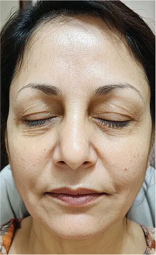 Yüz Dolgusu Öncesi Sonrası